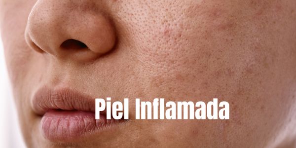 Piel Inflamada